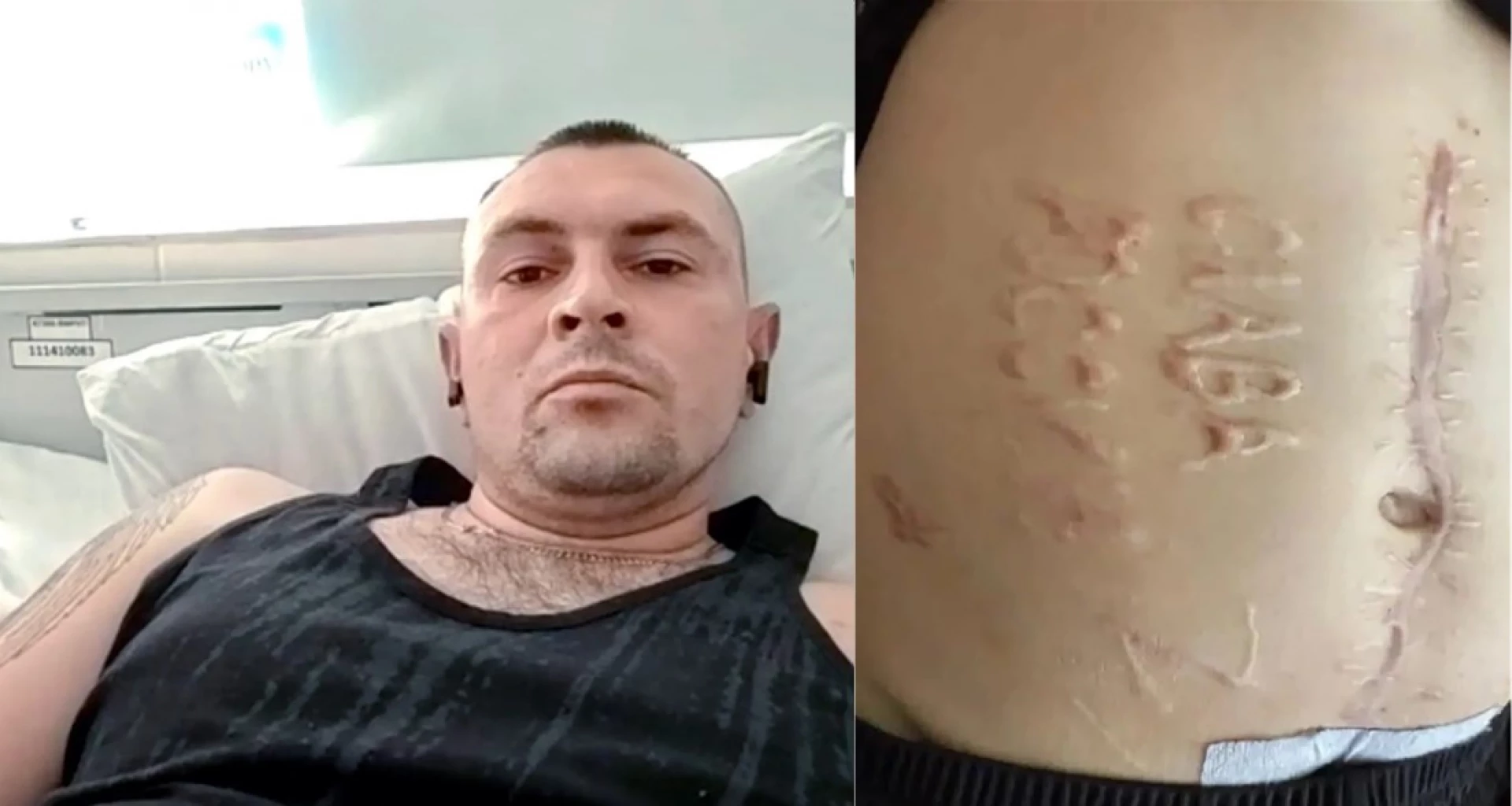 Військовий, якому зробили тавро «Слава Росії» на животі, готовий помститися ворогу