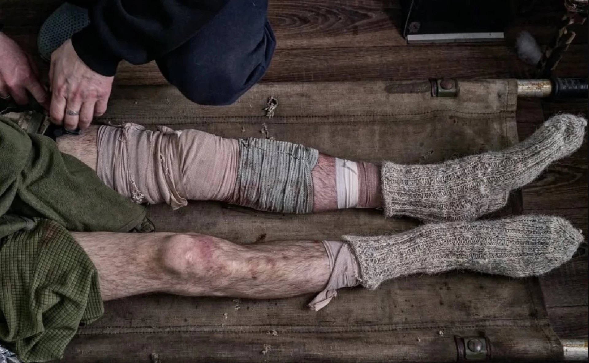 Газова гангрена повертається до України – The Telegraph