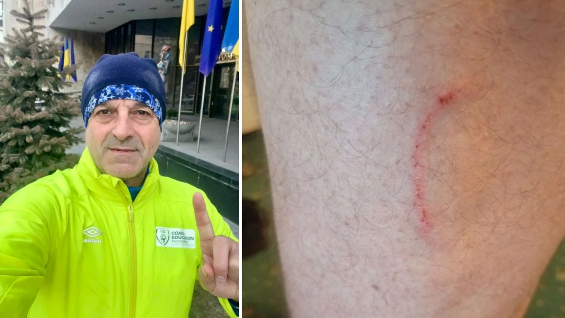 У столиці під час пробіжки в парку нардепа вкусила собака