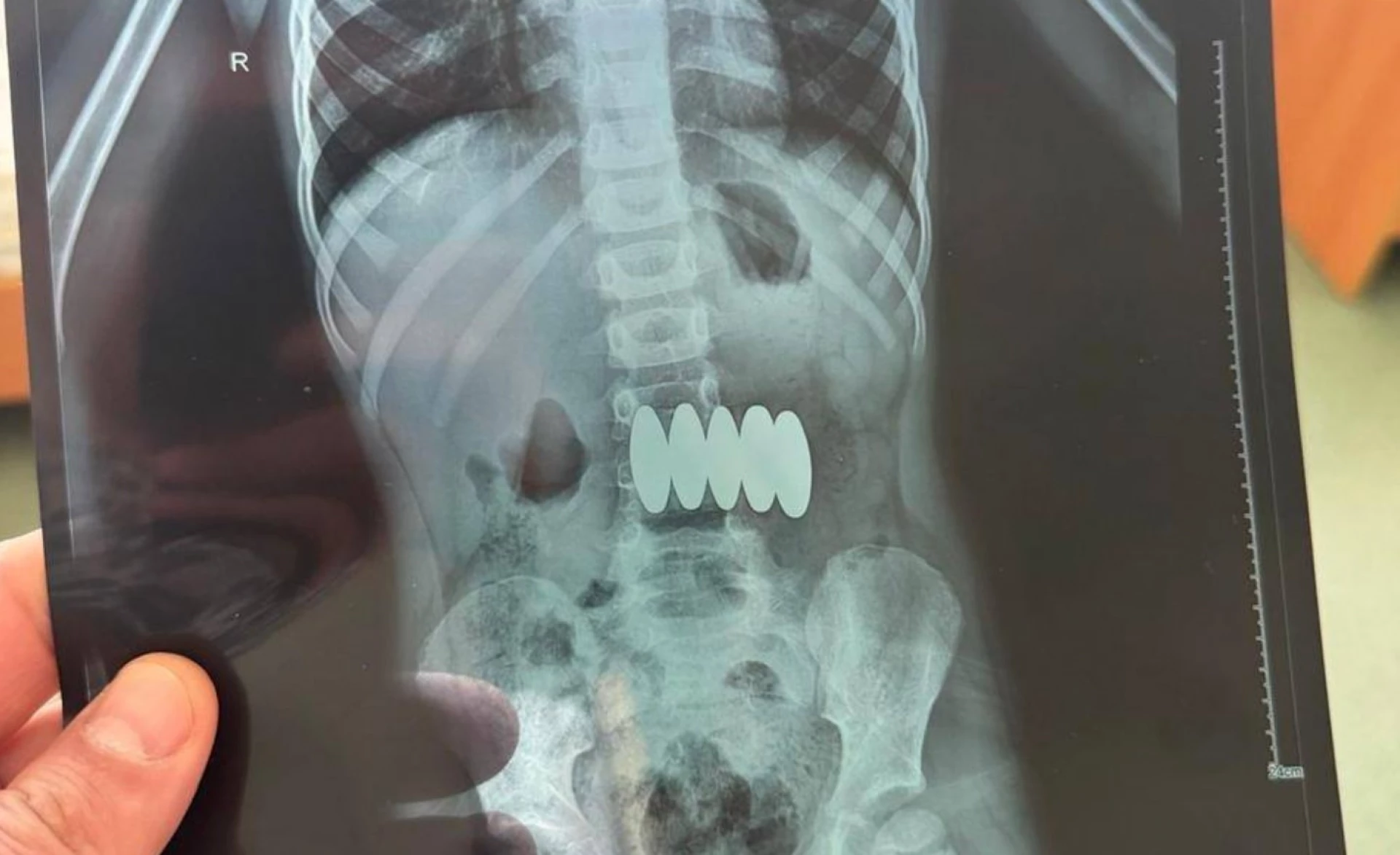 У Черкасах врятували дитину, яка проковтнула 4 магніти