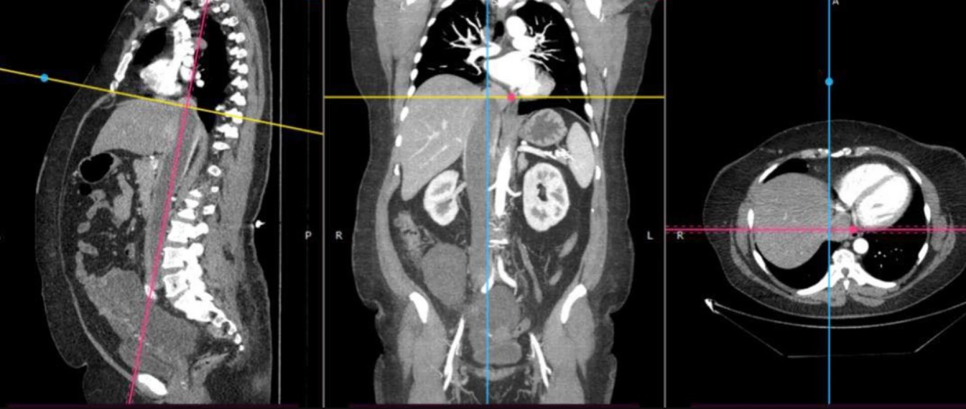 Пухлина з матки дісталася серця – львівські хірурги врятували життя 52-річній пацієнтці