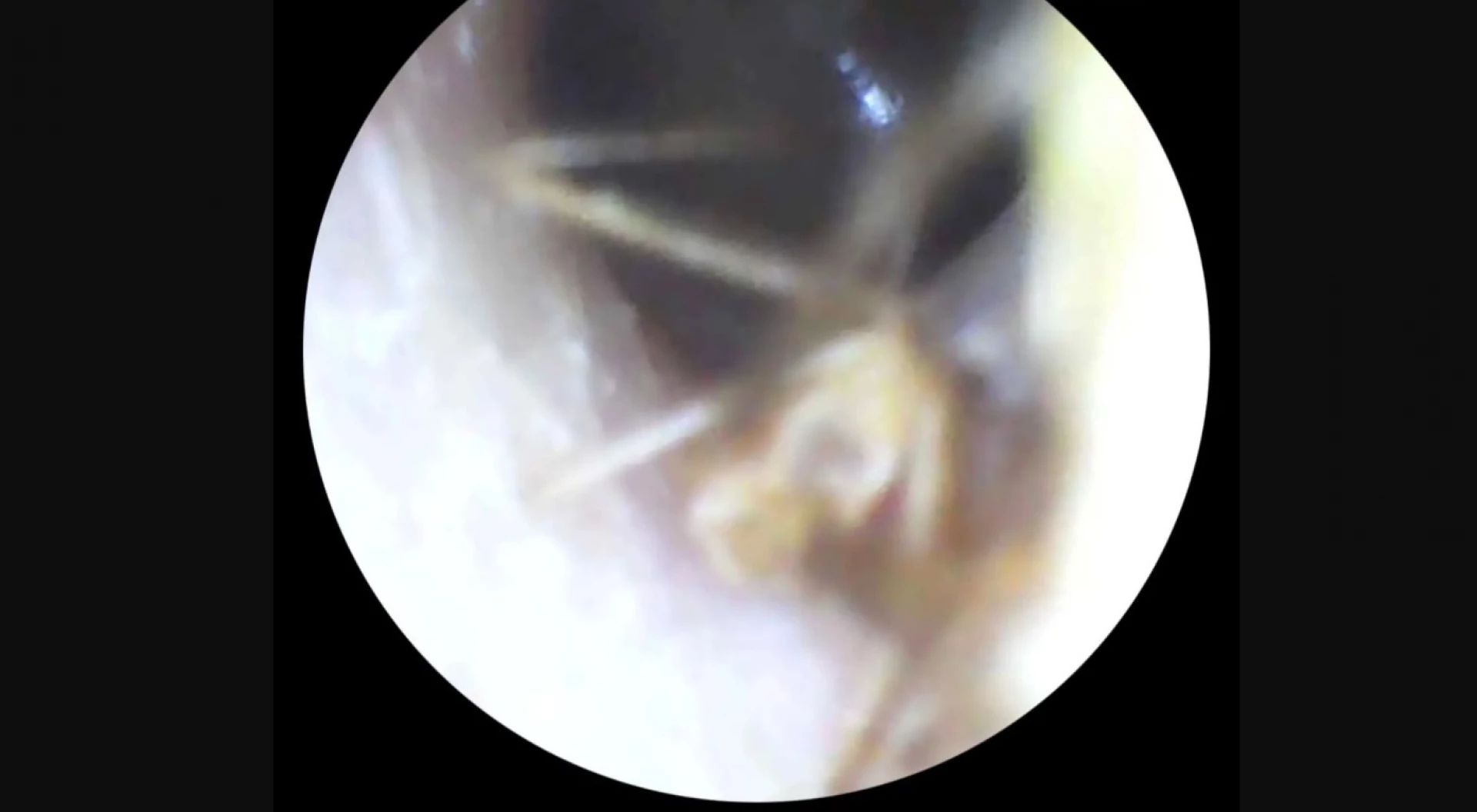 Павук заліз у вухо жительки Івано-Франківська