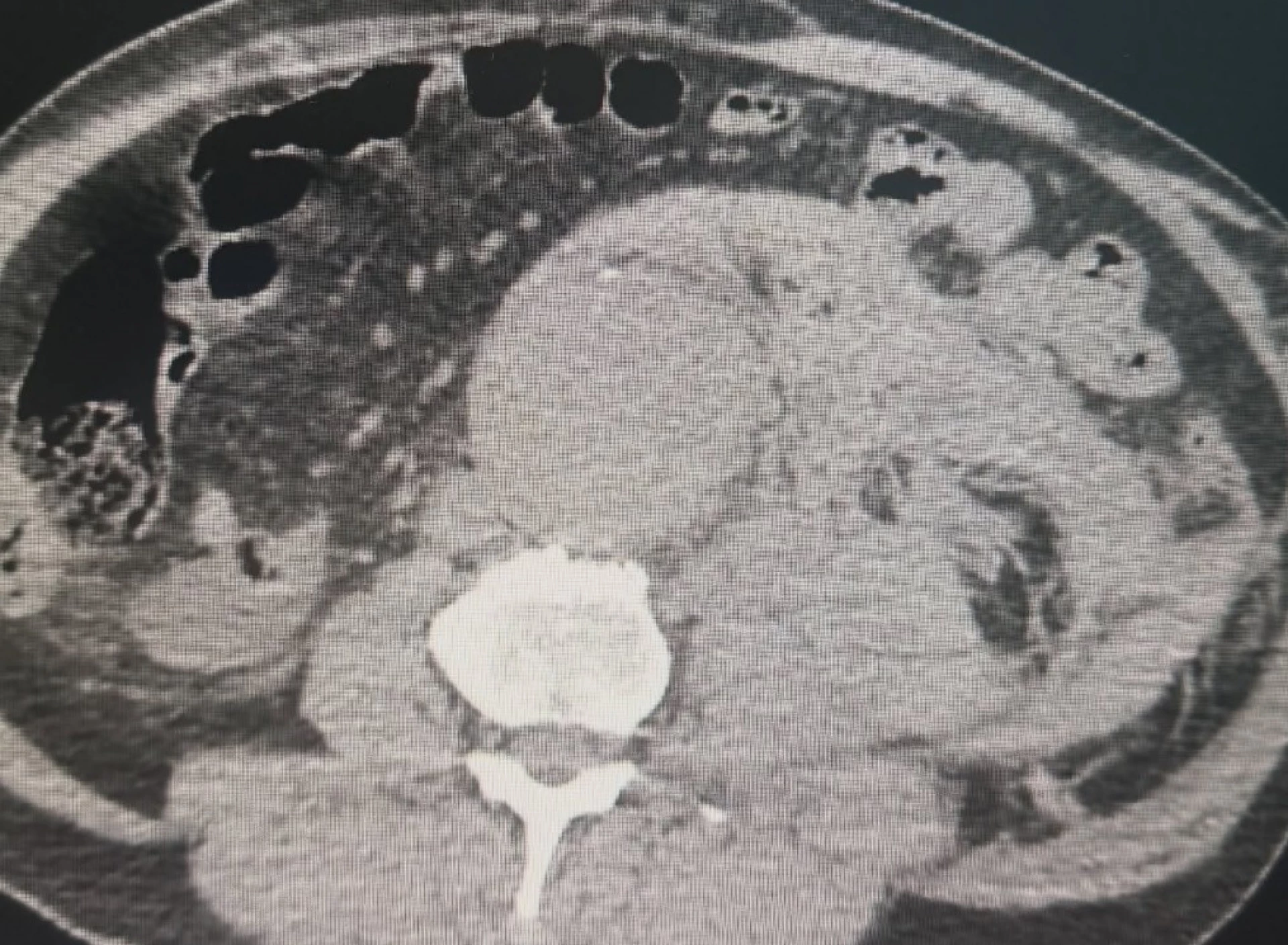 Рахунок йшов на хвилини: у черкаській лікарні врятували пацієнта з розривом аневризми аорти