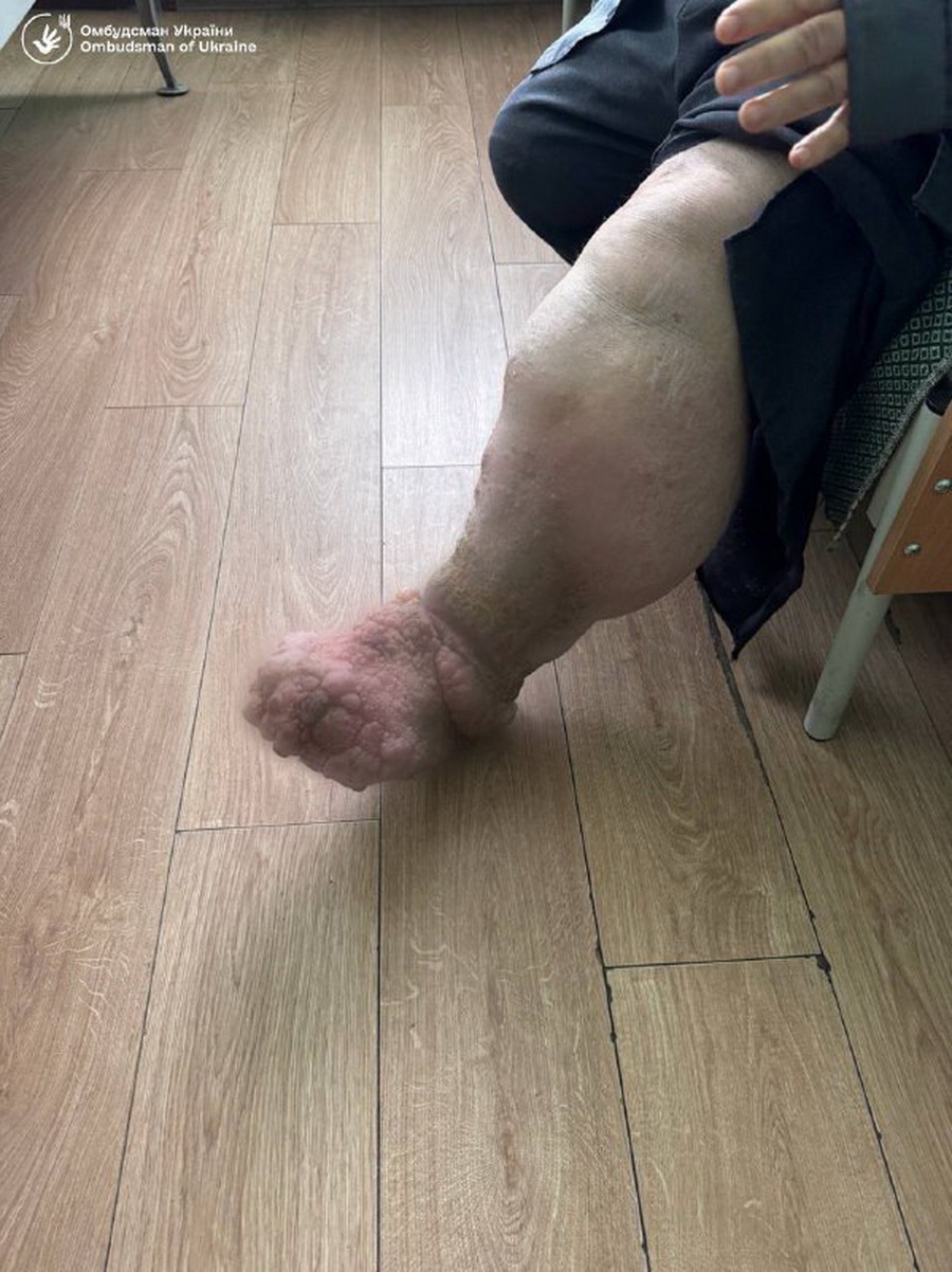 Що відбувається у психоневрологічному інтернаті на Вінниччині, звідки показали шокуюче фото ноги пацієнта