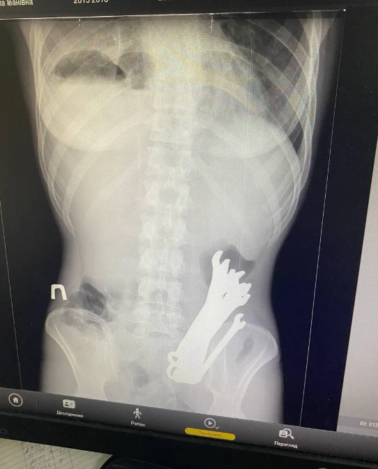 В Черкасах лікарі врятували чоловіка, у шлунку якого знайшли шість гайкових ключів - фото 2