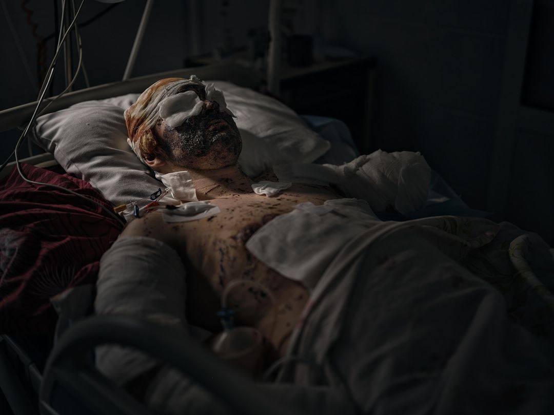 Антон втратив руки, ногу і око. Фотографи Лібертови розповіли історію українського воїна - фото 10