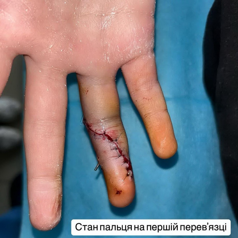 Вінницькі медики врятували палець хлопчика, який впав з самоката і отримав перелом