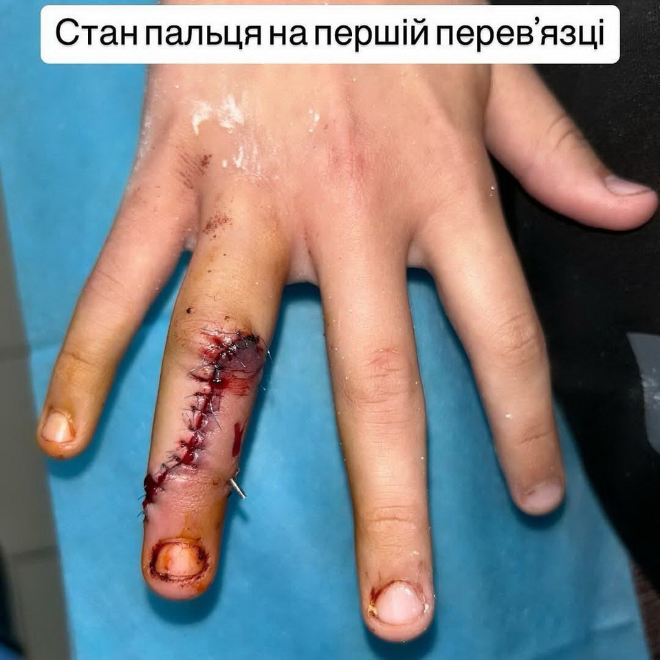 Вінницькі медики врятували палець хлопчика, який впав з самоката і отримав перелом - фото 2