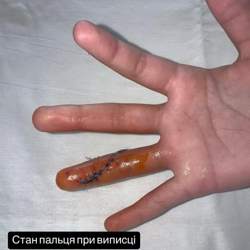 Вінницькі медики врятували палець хлопчика, який впав з самоката і отримав перелом - фото 3