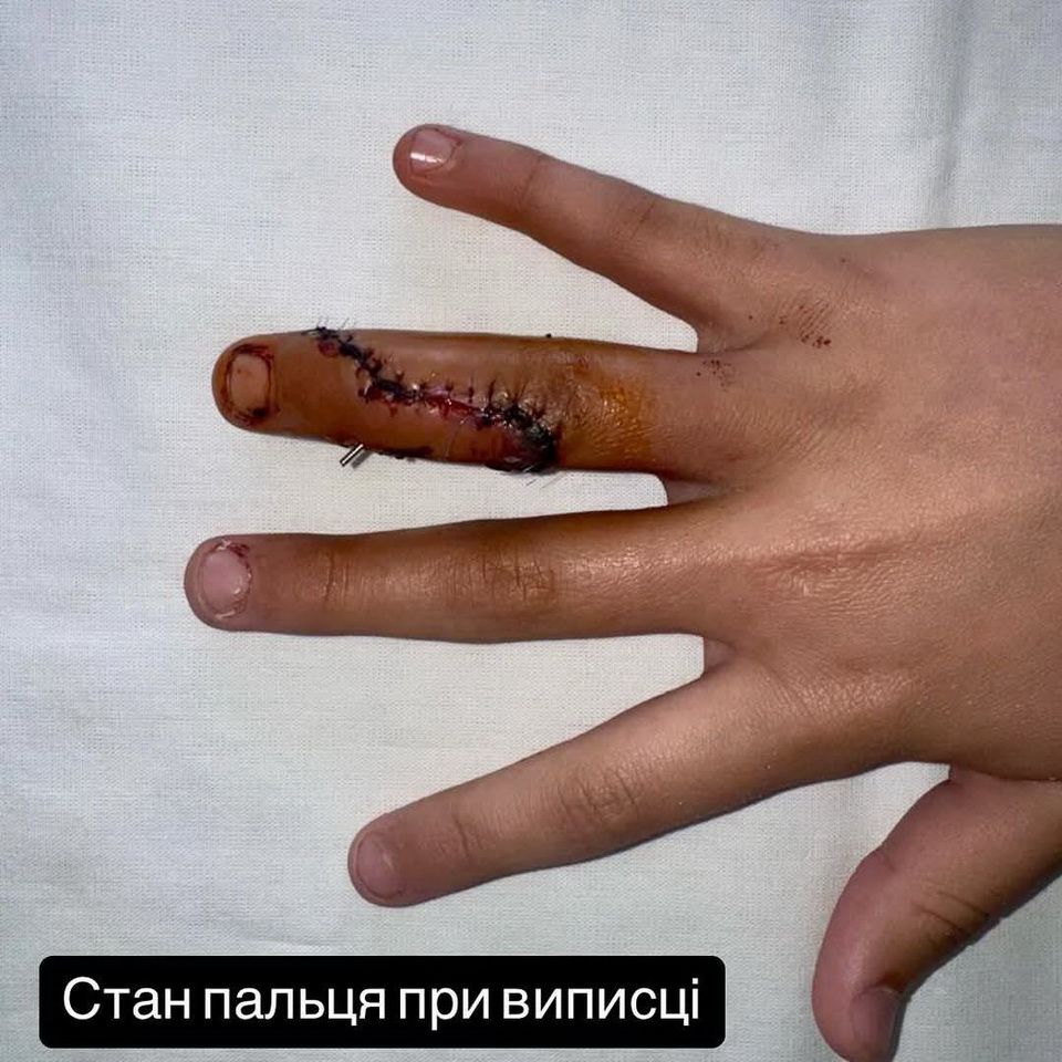 Вінницькі медики врятували палець хлопчика, який впав з самоката і отримав перелом - фото 4