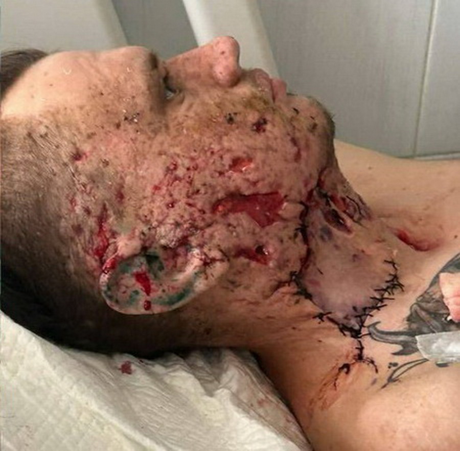 Вінницькі лікарі повернули до життя військового після важких поранень обличчя й шиї