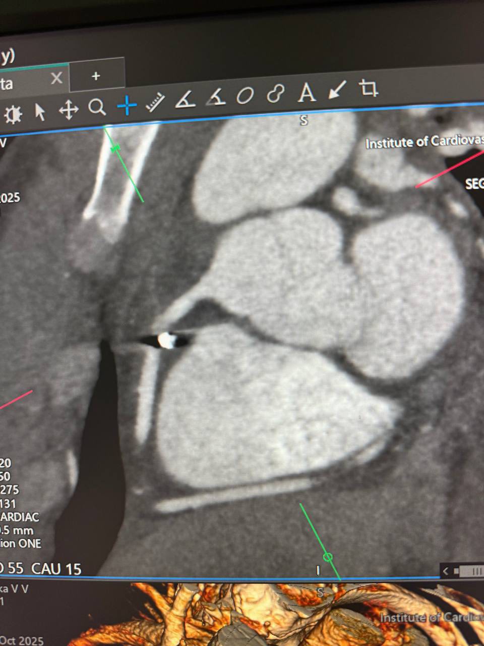 Київські лікарі видалили уламок із серця пораненого під час обстрілу в Чернігові - фото 2