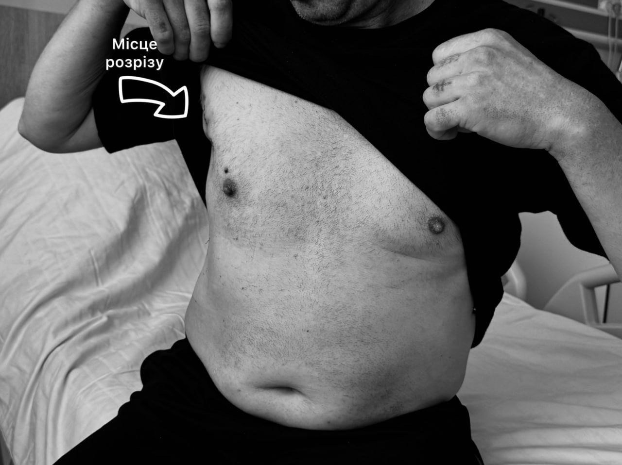 Жителю Львівщини замінили аортальний клапан через невеликий розріз під пахвою