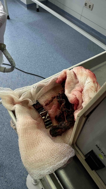 Дванадцять магнітів дістали з дитини вінницькі лікарі - фото 4