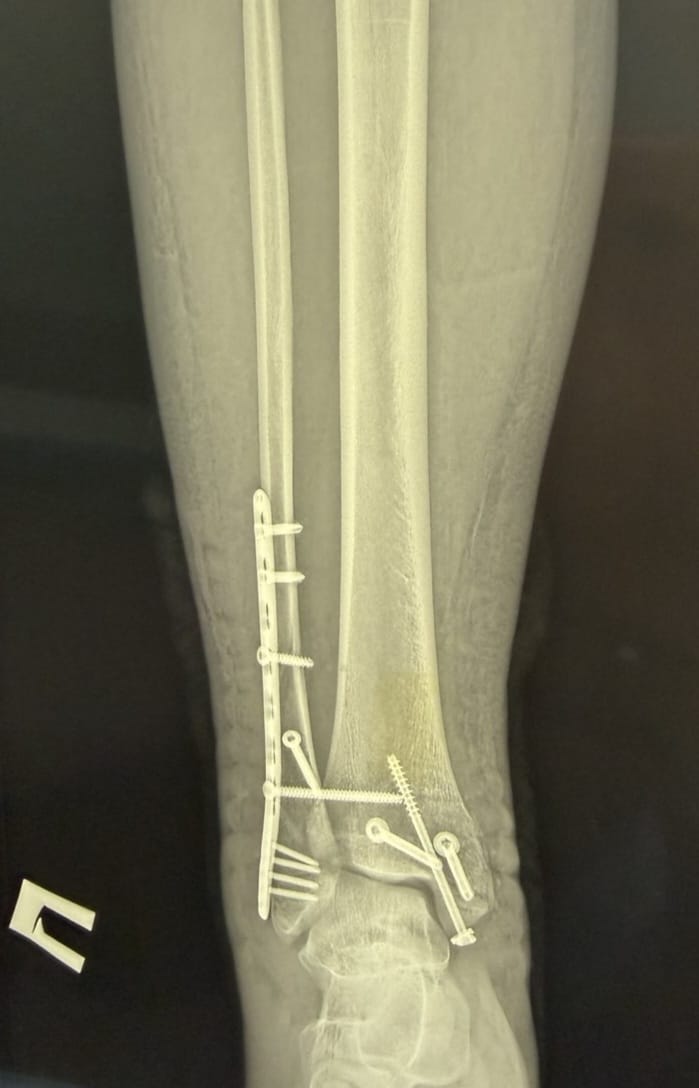 У Вінниці провели складну операцію підлітку, після падіння з самоката