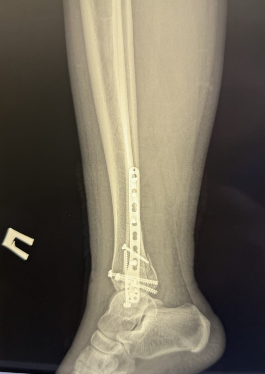 У Вінниці провели складну операцію підлітку, після падіння з самоката - фото 2