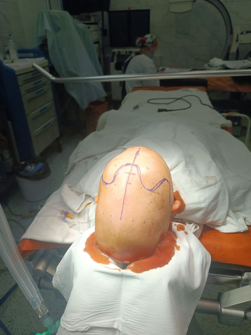 Київські лікарі прооперували дитину з рідкісним дефектом черепа