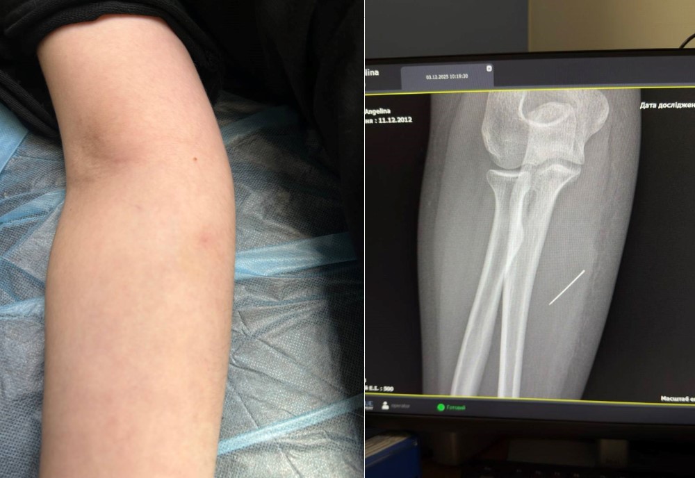 На Львівщині школярка випадково загнала голку в руку і шокувала лікарів