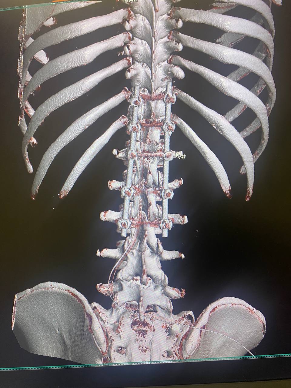 У Києві лікарі врятували дитину з важкою травмою хребта