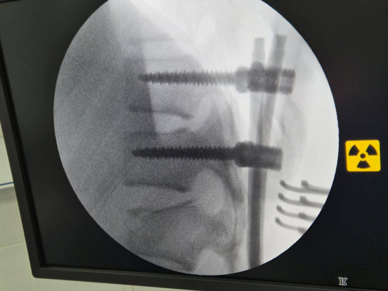 У Києві лікарі врятували дитину з важкою травмою хребта - фото 2