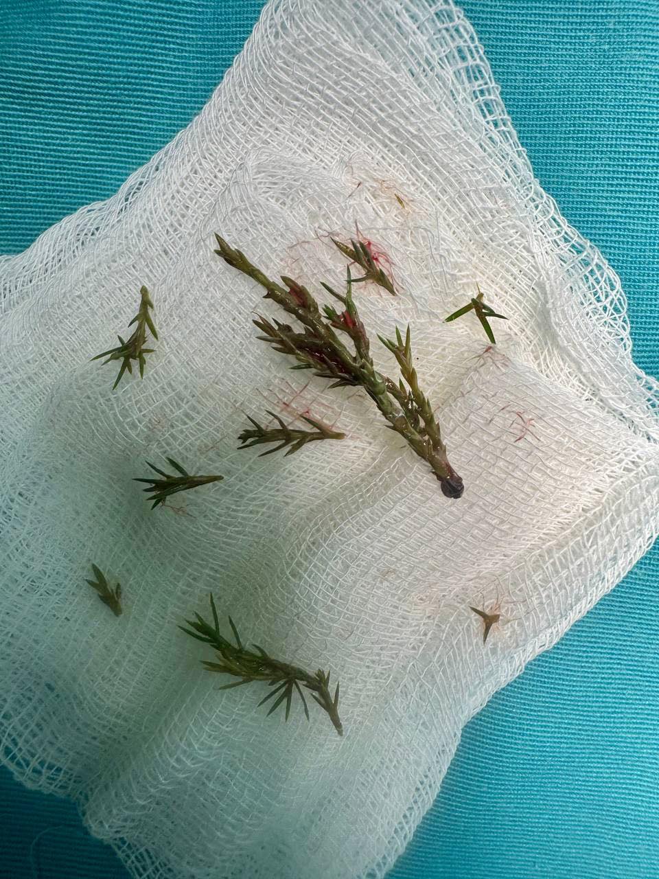 Ялинка у бронхах та трахеї: лікарі «Охматдиту» врятували 8-місячну дитину - фото 2