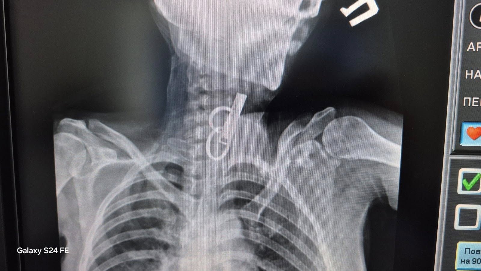 На Тернопільщині лікарі дістали ключа зі стравоходу жінки