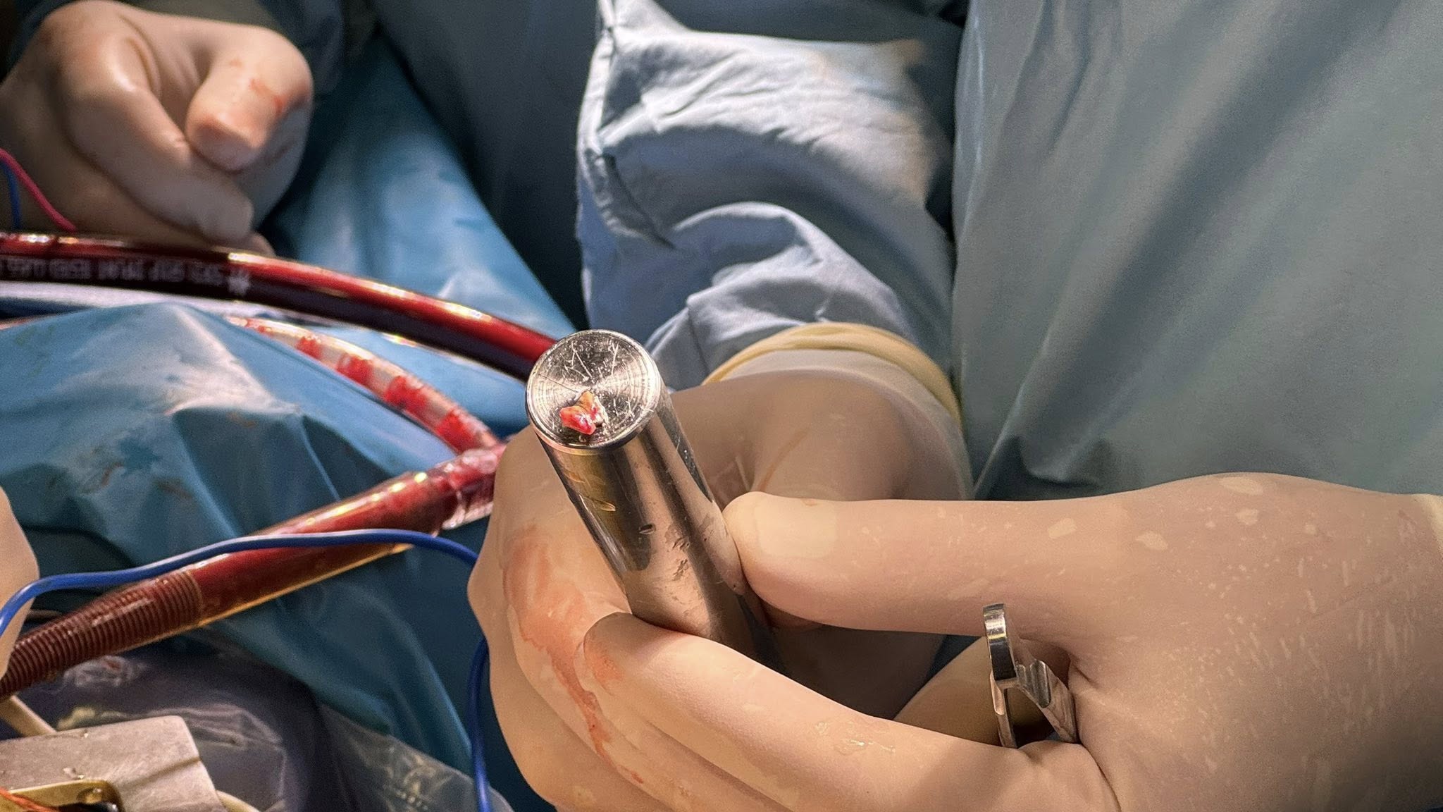 «Ми будемо боротися за кожен удар серця»: київські кардіохірурги розповіли про порятунок військового