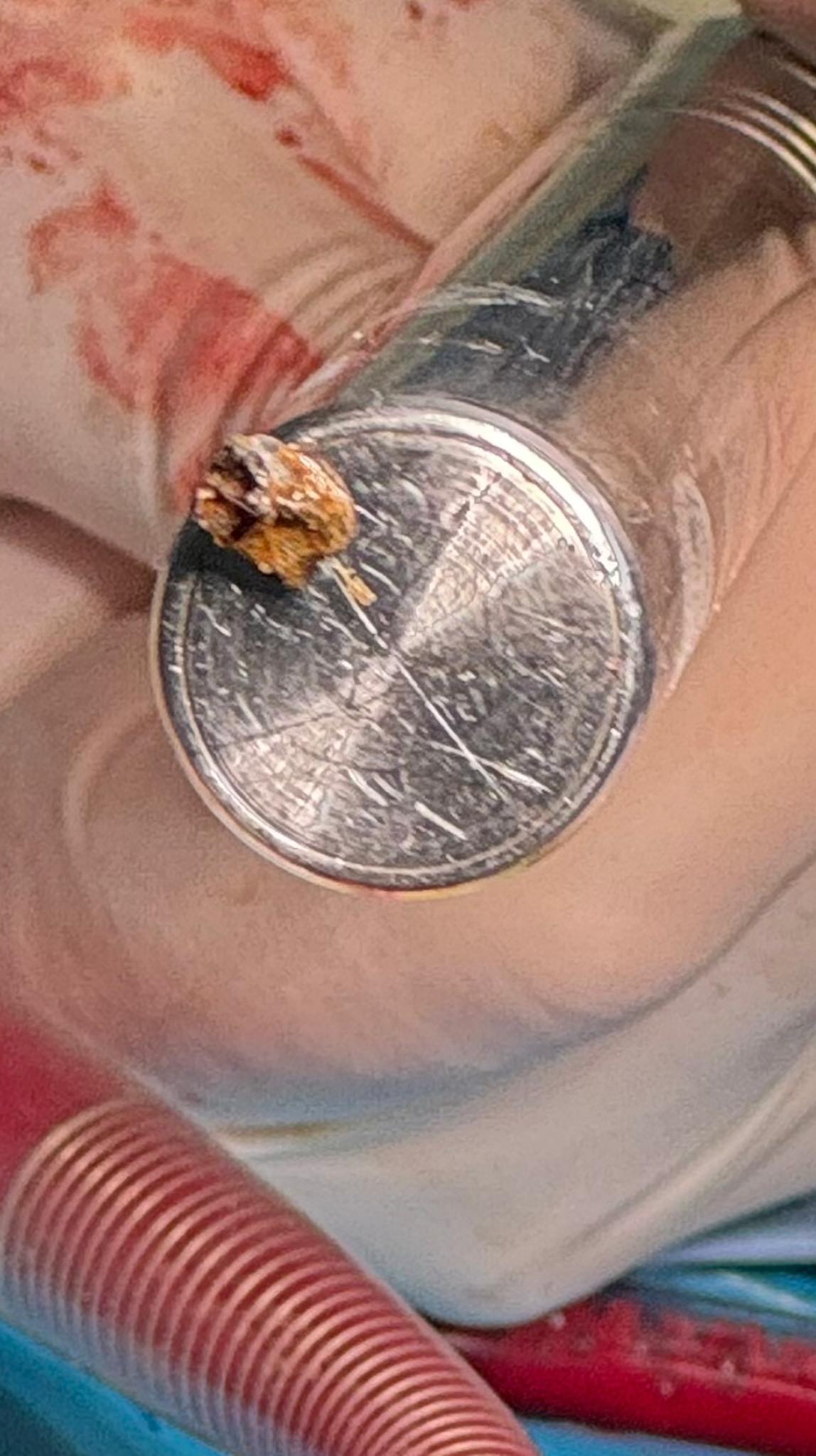 Київські кардіохірурги врятували життя військовому, видаливши металевий уламок із серця - фото 2