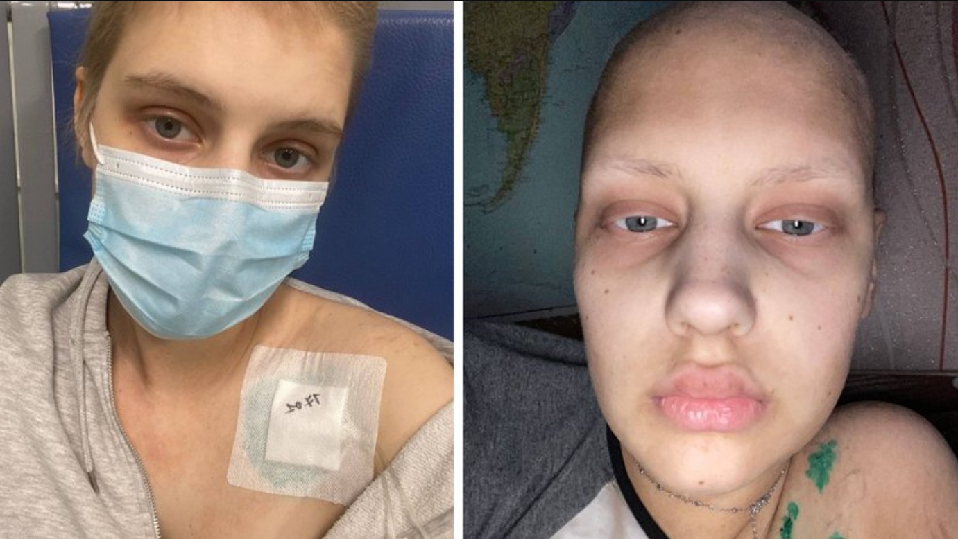 Тато зістриг волосся. Історія Валерії з Черкащини, яка бореться з онкологією