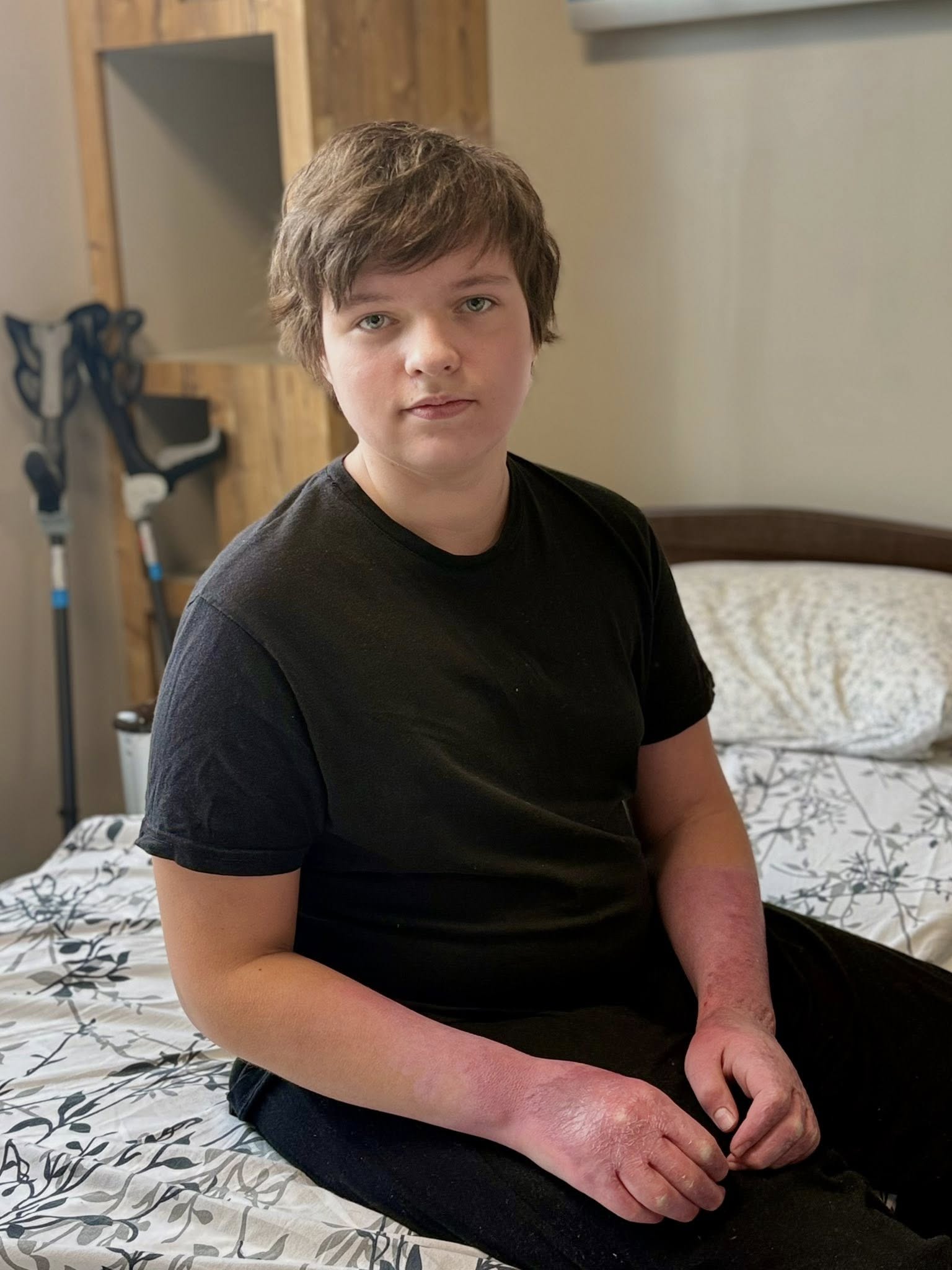 Пів року боротьби за відновлення: в Охматдиті врятували 13-річного хлопця з опіками 40% тіла