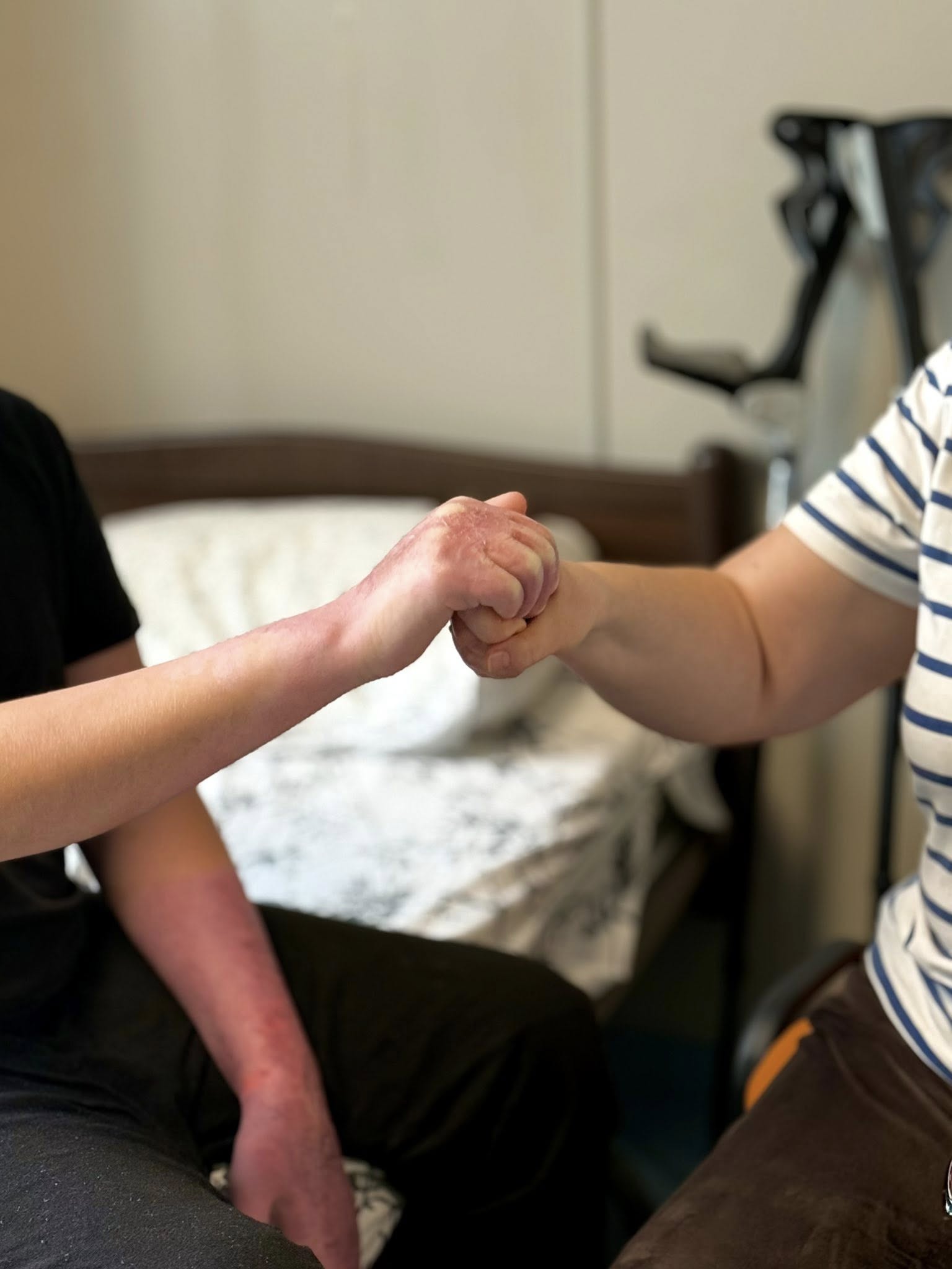 Пів року боротьби за відновлення: в Охматдиті врятували 13-річного хлопця з опіками 40% тіла - фото 2