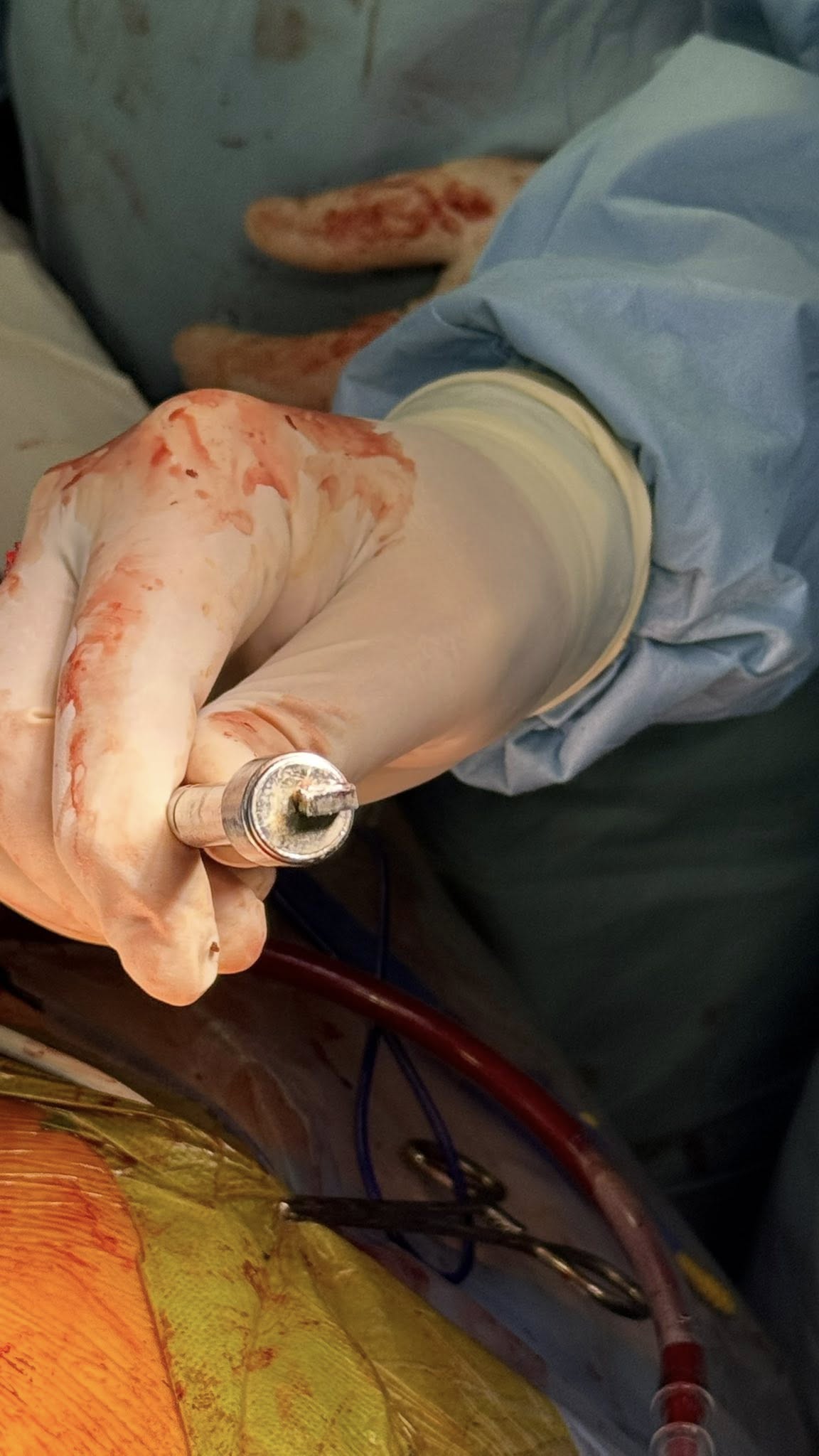 Київські кардіохірурги врятували військового з уламком у серці