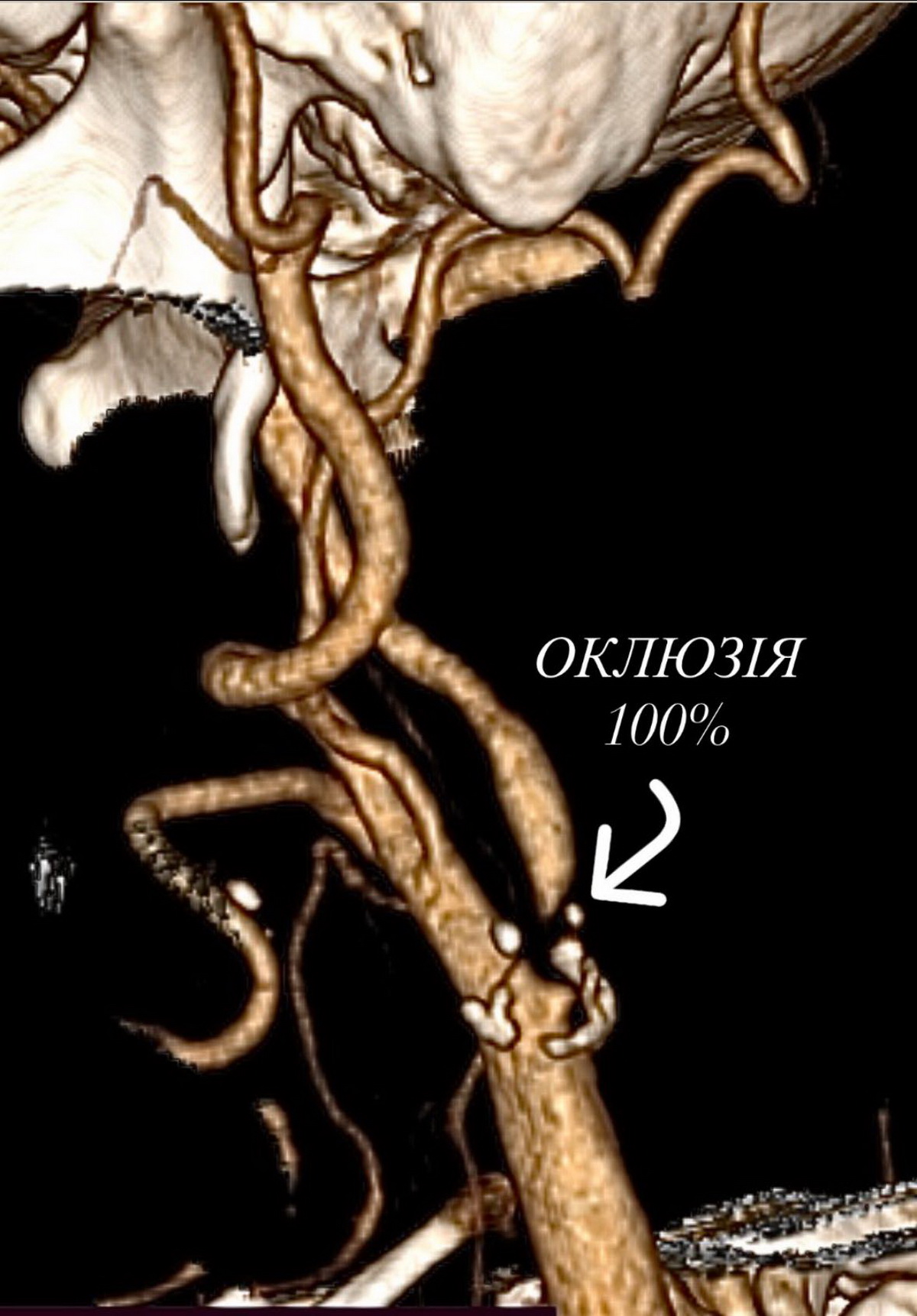 У вінницькій «пироговці» провели успішну операцію пацієнту з повним перекриттям судини, що живить мозок