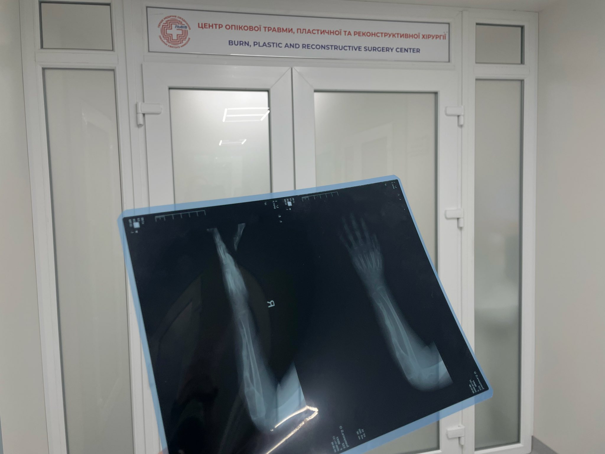 Бактерії дірявили кістку, наче сир. У Львові дівчинці відростили 4 см руки - фото 4