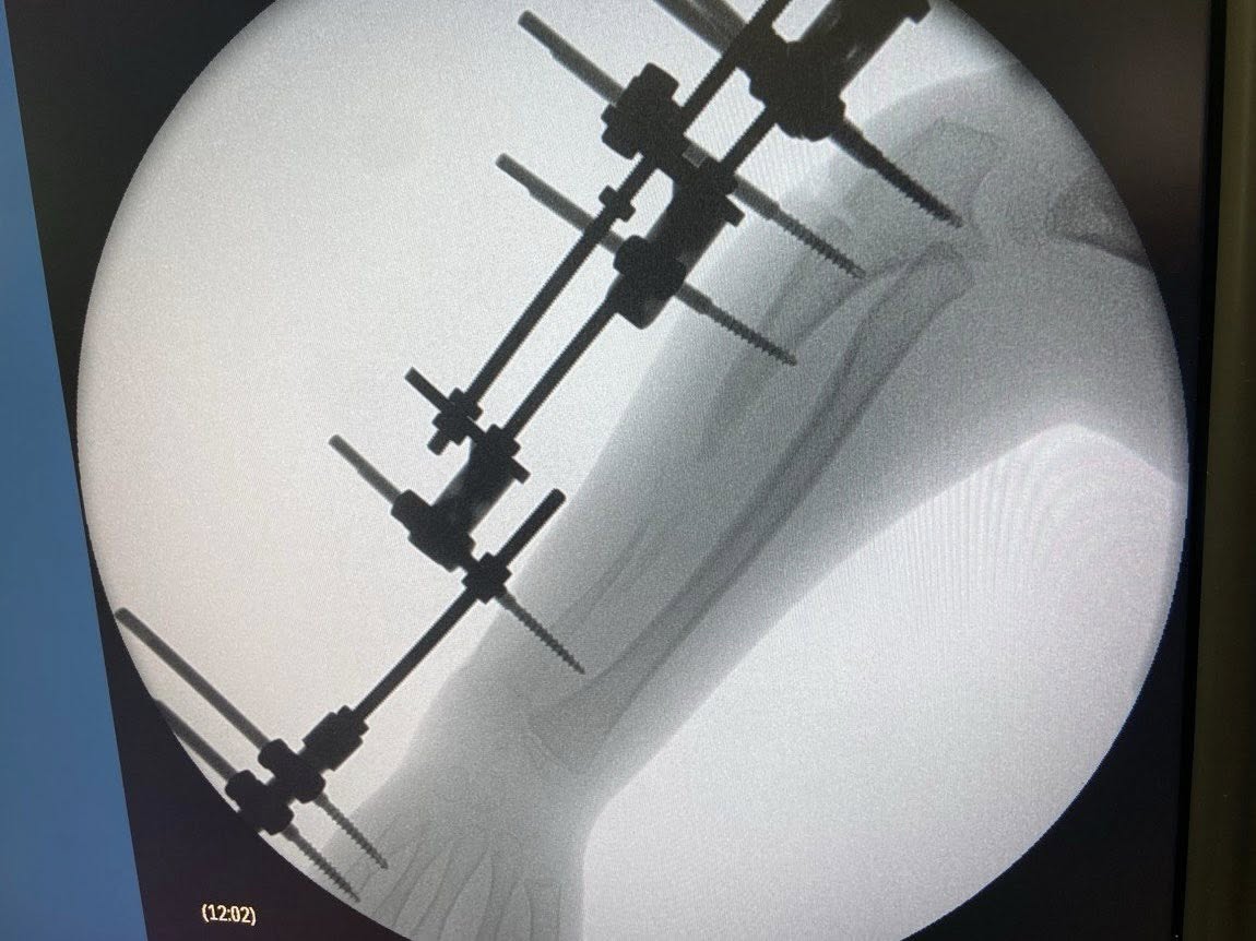 Бактерії дірявили кістку, наче сир. У Львові дівчинці відростили 4 см руки - фото 5