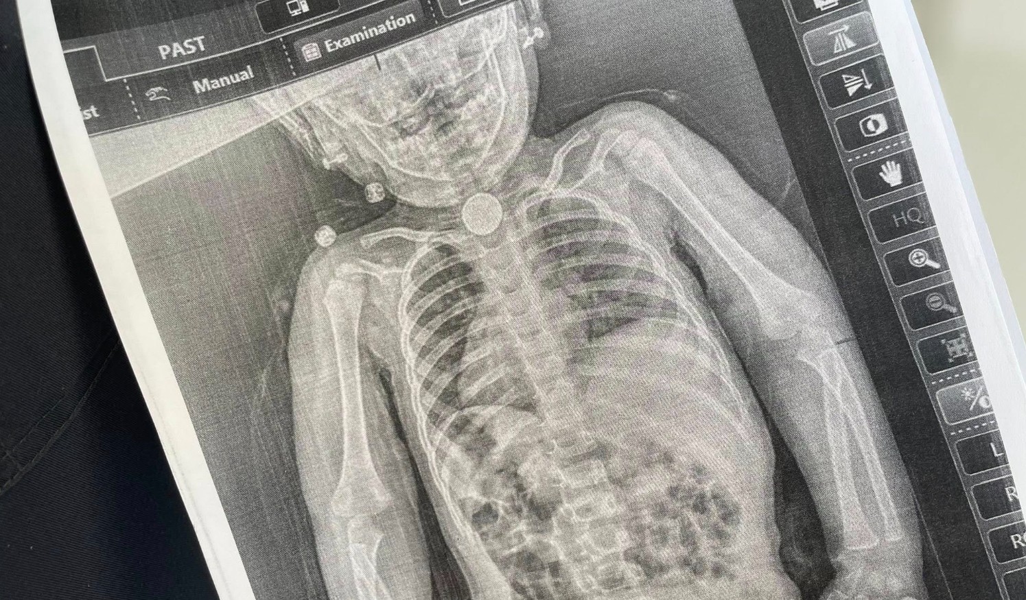 У Львові хірурги врятували 2-річну дитину, яка всю зиму прожила із батарейкою у стравоході