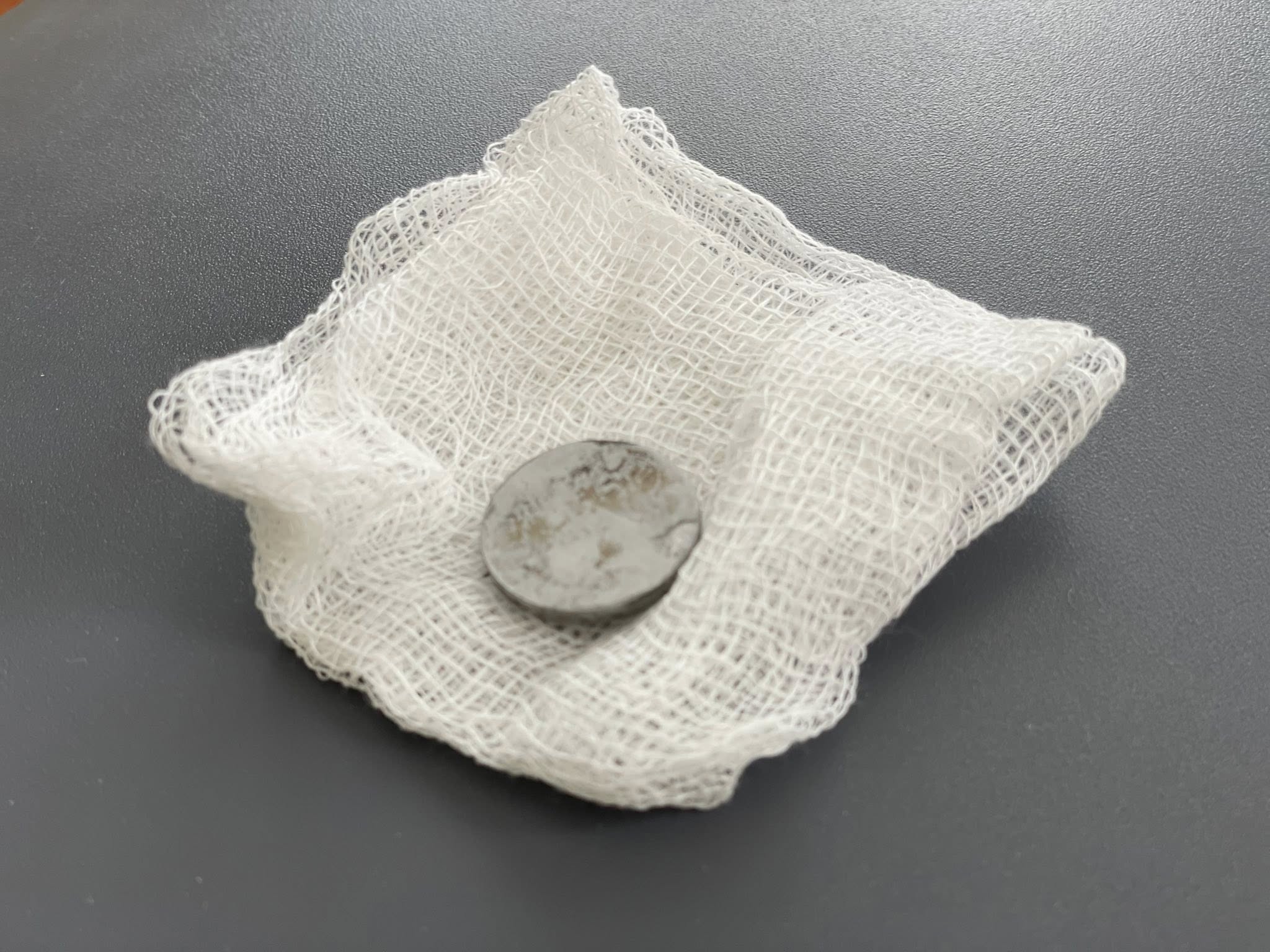 У Львові хірурги врятували 2-річну дитину, яка всю зиму прожила із батарейкою у стравоході - фото 2