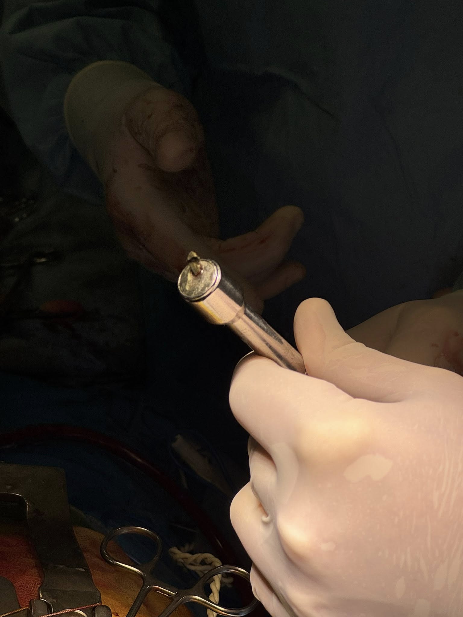 У Києві медики дістали уламок із серця військового