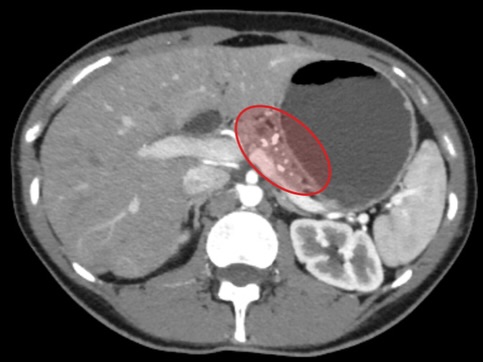 Столичні хірурги врятували 29-річну жінку з рідкісним захворюванням підшлункової