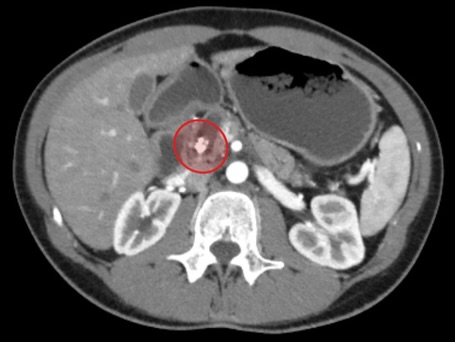 Столичні хірурги врятували 29-річну жінку з рідкісним захворюванням підшлункової - фото 2