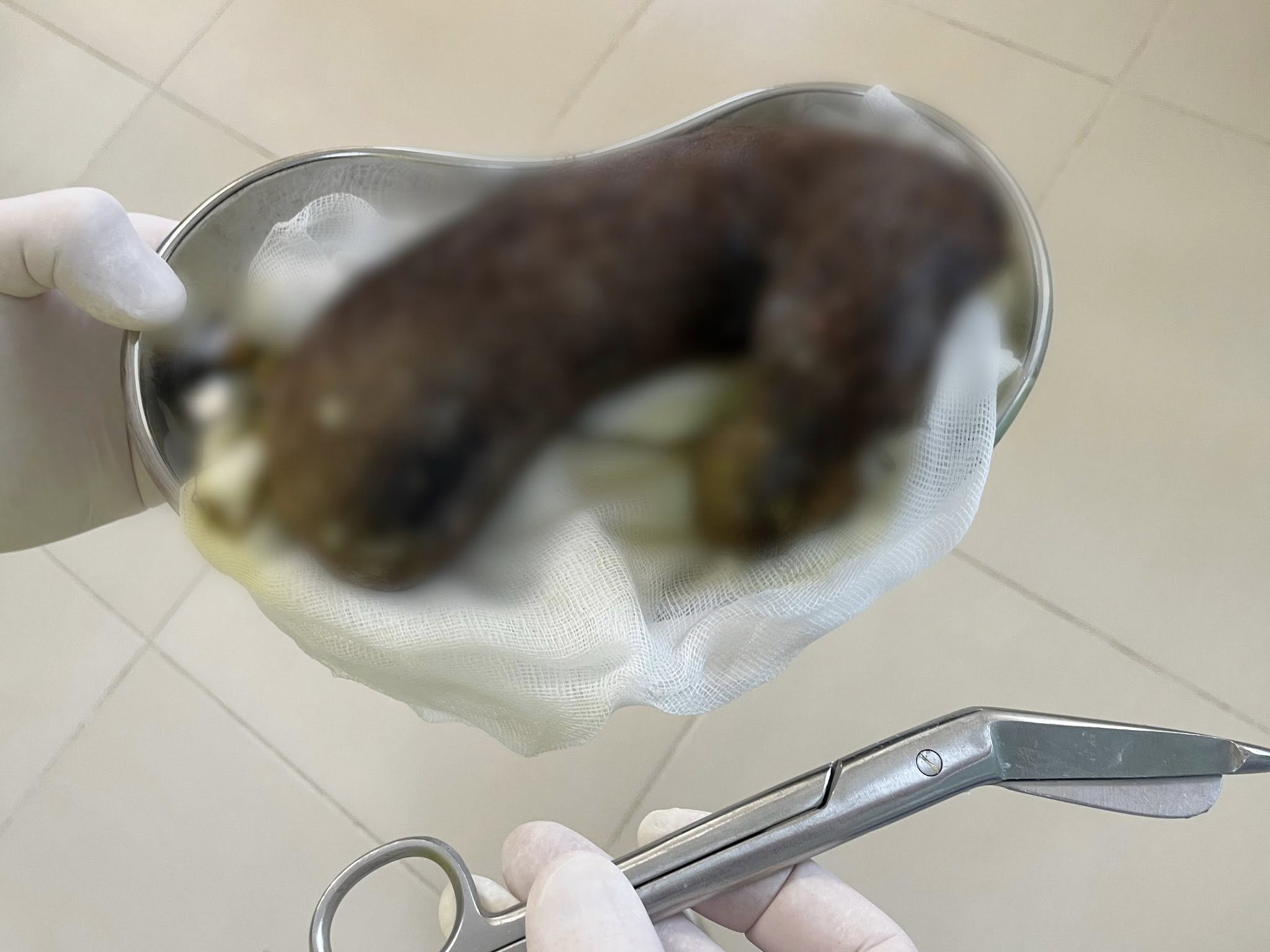 Синдромом Рапунцель: врятували дівчинку, яка роками їла власне волосся - фото 2