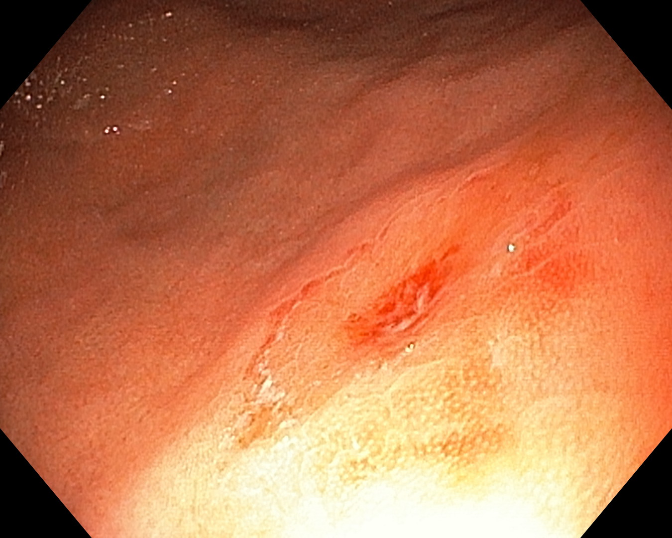 Київські медики дістали 17 магнітів із кишківника 5-річної дитини - фото 2