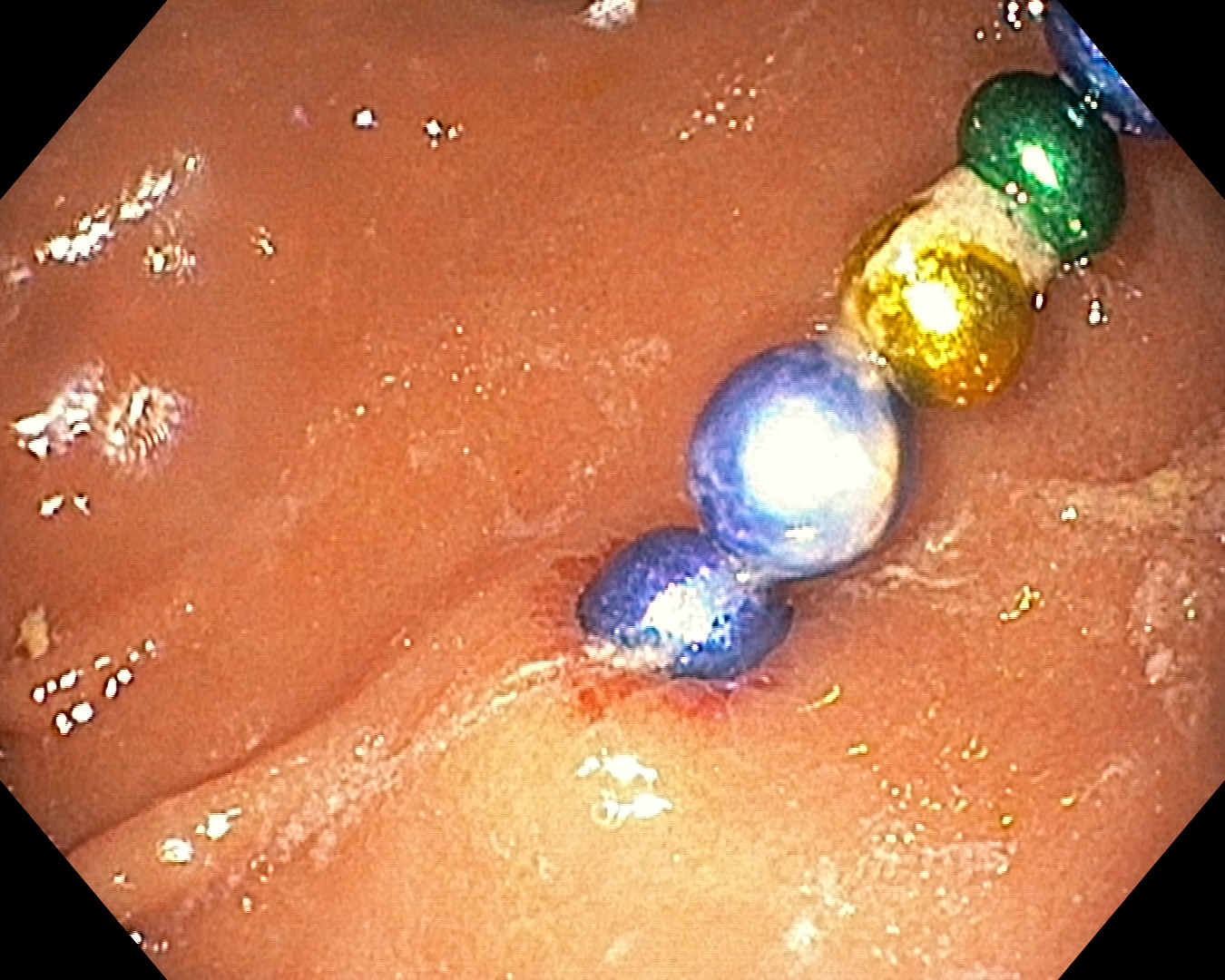 Київські медики дістали 17 магнітів із кишківника 5-річної дитини